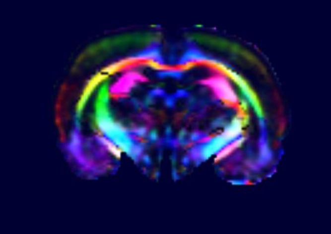 MRI mozg kolor DTI